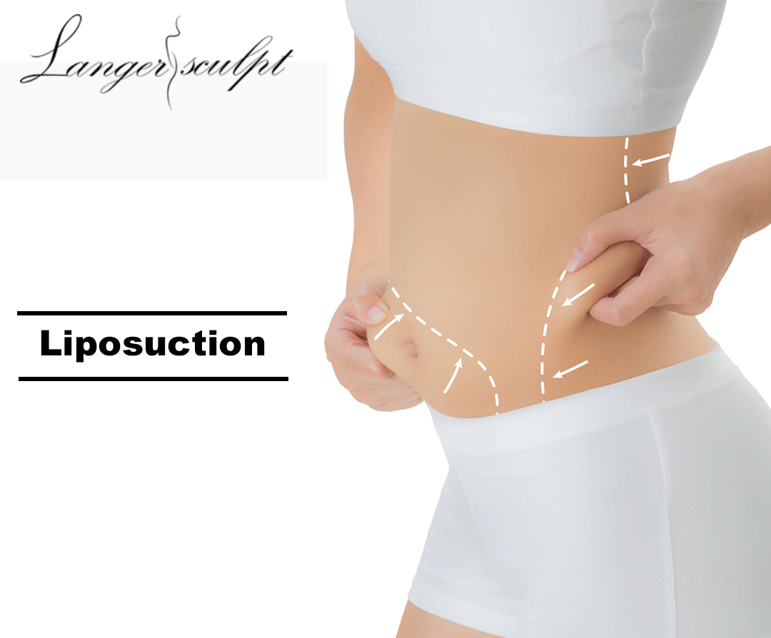 Liposuction Treatment: A Guide to Achieve Your Body Goals
