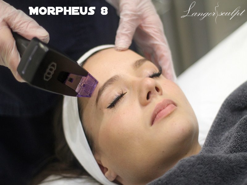 What is Morpheus 8 Treatment?