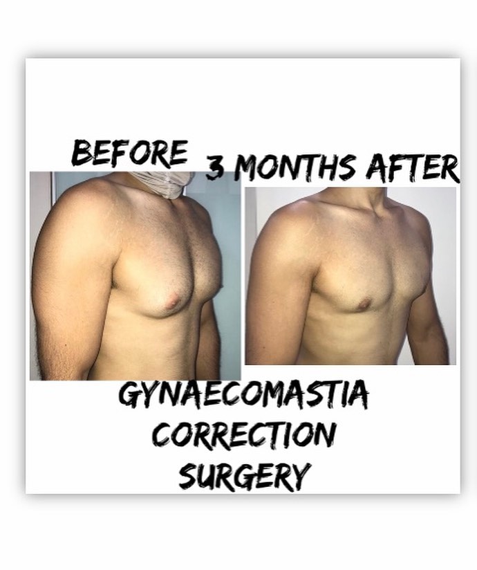Is it worth getting gynecomastia surgery?