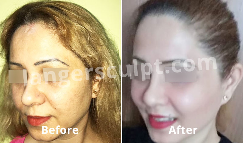 Vampire facial or Platelet Rich Plasma (PRP) for the Face for acne scars and uneven skin tone