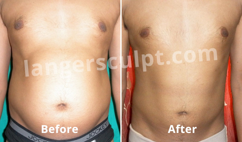 Liposuction for the Abdomen in a Male