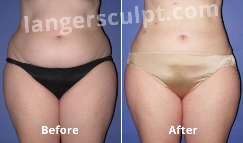 Liposuction for the Abdomen and Love handles