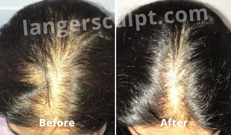 Platelet Rich Plasma (PRP) treatment for Hair loss and fall