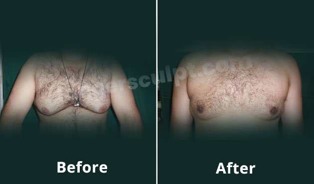 Liposuction for Gynecomastia